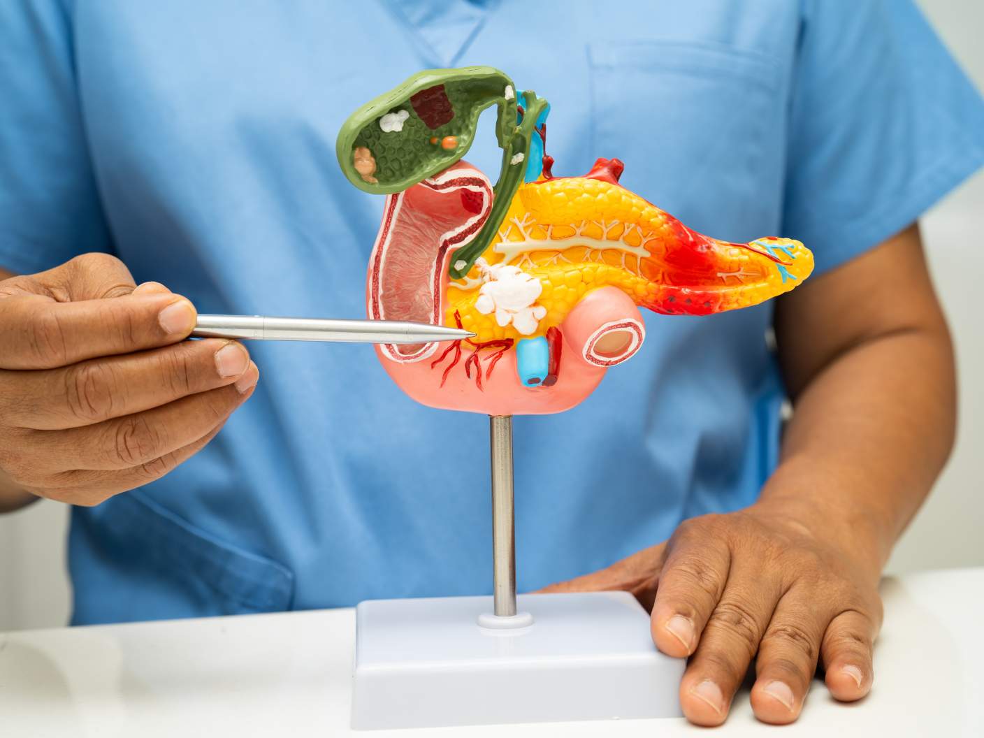 Pancreatic Cancer